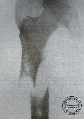 Рентгеновский снимок перелома бедренной кости при раковых метастазах