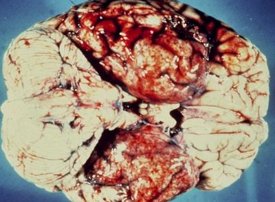 Мозг больного японским энцефалитом