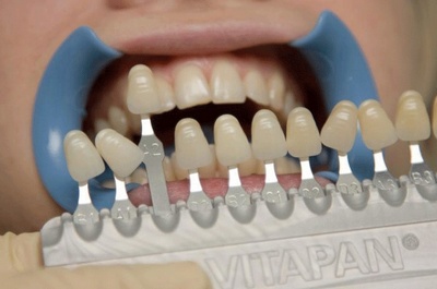 Классификация цвета зубов Бранда по отношению его к кариесу