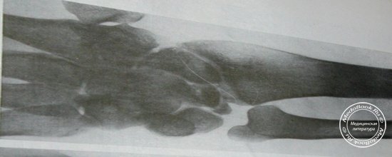 Ладонный рентгеновский снимок маляции полулунной кости на поздней стадии