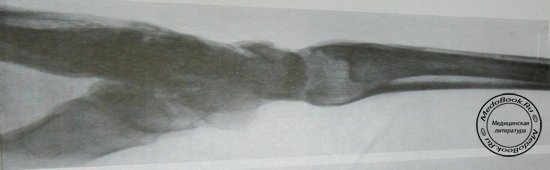 Боковой рентгеновский снимок маляции полулунной кости на поздней стадии