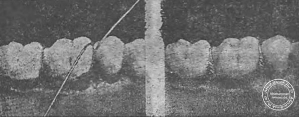 Сепарация зубов проволочной лигатурой из серебра (Korkhaus)