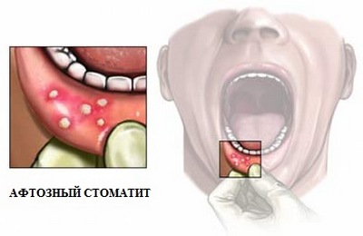 Афтозный стоматит - один из триады симптомов спру