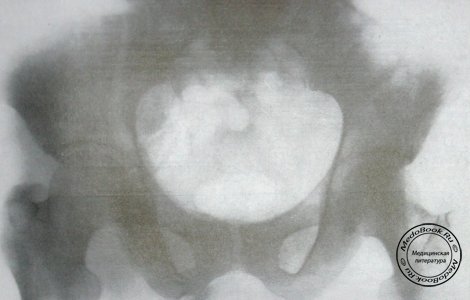 Снимок в прямой проекции перелома крыла подвздошной кости и вертлужной впадины