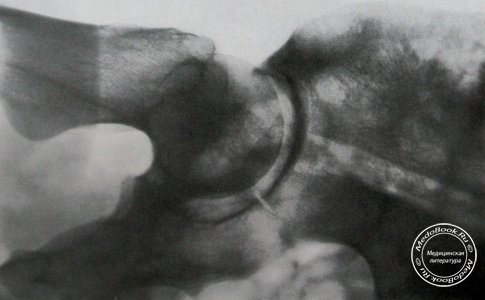Снимок с поворотом кнаружи перелома крыла подвздошной кости и вертлужной впадины