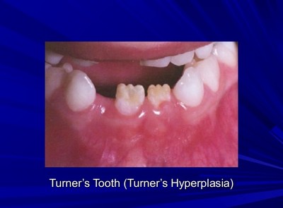 Зубы Турнера (Turner)