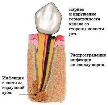 Фокус хронической инфекции в зубу