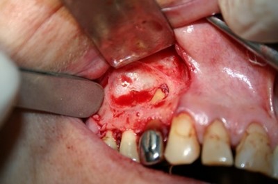 Хирургическое лечение кисты зуба