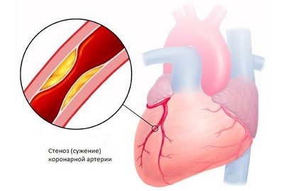 Стеноз коронарной артерии - причина стенокардии