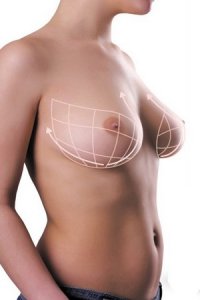 Пластическая хирургия на страже красивой женской груди