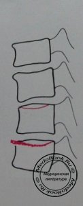Схема к боковому рентгеновскому снимку перелома 11 и 12 грудных позвонков