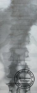Задний рентгеновский снимок перелома 11 и 12 грудных позвонков