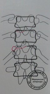 Схема к заднему рентгеновскому снимку перелома 11 и 12 грудных позвонков