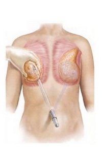 Увеличение груди путем пересадки жира по Рену