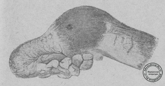 Карциноид червеобразного отростка (Наблюдение В.А. Ланге, из коллекции Э.Р. Гессе).