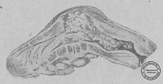 Карциноид червеобразного отростка в разрезе (Наблюдение В.А. Ланге, из коллекции Э.Р. Гессе).