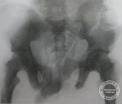 Перелом таза по Мальгеню на рентгеновском снимке