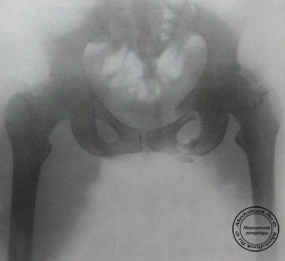 Перелом костей таза по Мальгеню на рентгеновском снимке