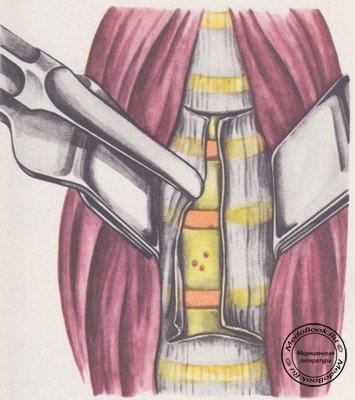 Отслоение передней продольной связки тел шейных позвонков распатором