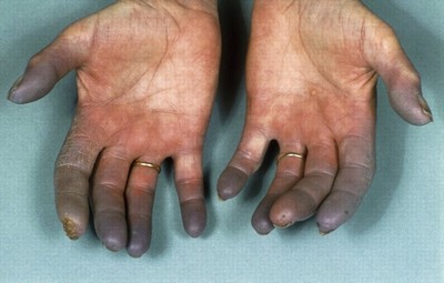 Пальцы больного болезнью Рейно