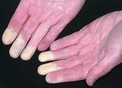 Побледнение пальцев при приступе акропарестезии