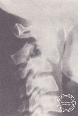 Разрыв дужки и передний спондилолистез C2 на рентгенограмме