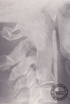 Сращение поврежденной дужки C2 на рентгенограмме