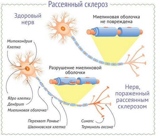 Повреждение миелиновых оболочек нервов при рассеянном склерозе