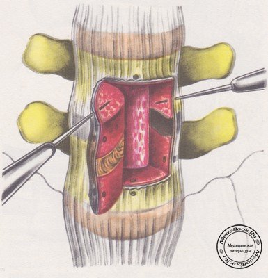 Проведение нитей через костные каналы в лигаменто-оссальной крыше