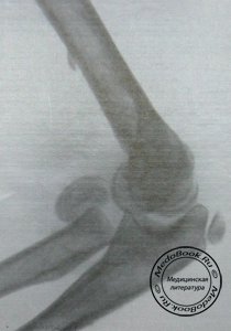 Боковой рентгеновский снимок перелома шейки лучевой кости у детей