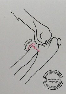 Схема к боковому рентгеновскому снимку перелома шейки лучевой кости у детей