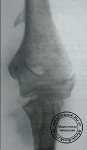 Задний рентгеновский снимок перелома шейки лучевой кости у детей