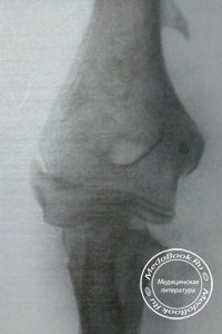 Перелом шейки лучевой кости у детей