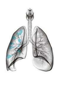 Пневмония и отек легких - причина дыхательной недостаточности
