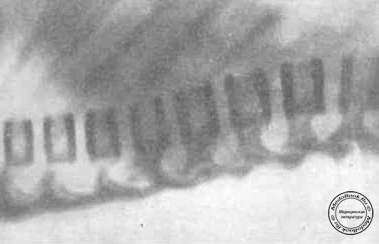 Рентгеновский снимок нижних грудных и поясничных позвонков девочки, страдающей «мраморной» болезнью
