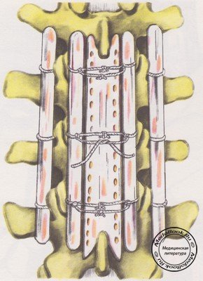 Завязывание нитей над костным трансплантатом при устойчивом спондилодезе поясничного отдела позвоночника