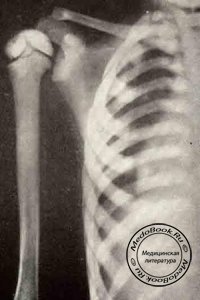 Мраморная болезнь - врожденный распространенный остеосклероз костей