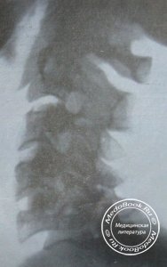 Боковой рентгеновский снимок полного вывиха 5 шейного позвонка с переломом суставного отростка