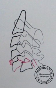 Схема к боковому рентгеновскому снимку полного вывиха 5 шейного позвонка с переломом суставного отростка