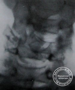 Сагиттальный рентгеновский снимок полного вывиха 5 шейного позвонка с переломом суставного отростка