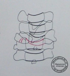 Схема к сагиттальному рентгеновскому снимку полного вывиха 5 шейного позвонка с переломом суставного отростка