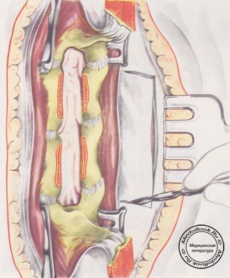 Выкраивание бокового фасциального лоскута до мышечного слоя