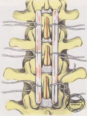 Крепление костных трансплантатов петлями нитей