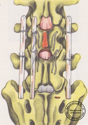 Крепление лизированной части дужки к боковому костному трансплантату отдельными швами