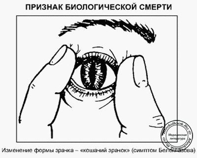 Симптом «кошачьего глаза» - признак биологической смерти