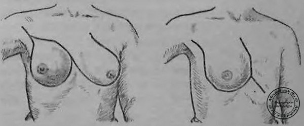 Пластическое закрытие дефекта грудной железы по Пайру (схематическое изображение операции)