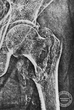 Межвертельный перелом шейки бедренной кости с вколачиванием шейки в межвертельную область бедра