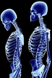 Изменения в костях скелета при болезнях Аддисона и Иценко-Кушинга