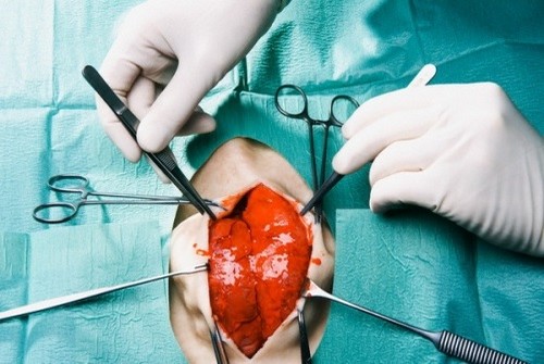 Лечение пороков сердца