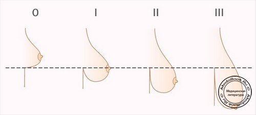 Степени мастоптоза (опущения груди)